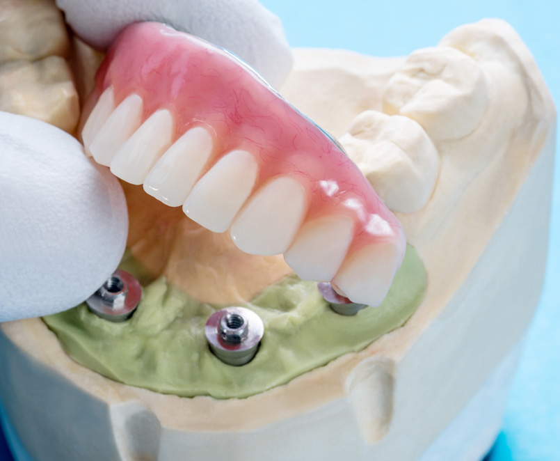 toronto bridge protesi fissa denti affi